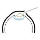 眼内レンズ挿入