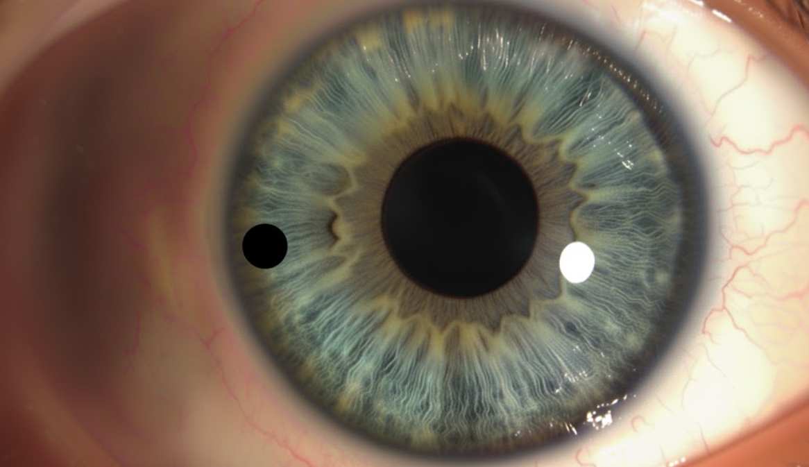 虹彩レーザー治療のダイアグラム