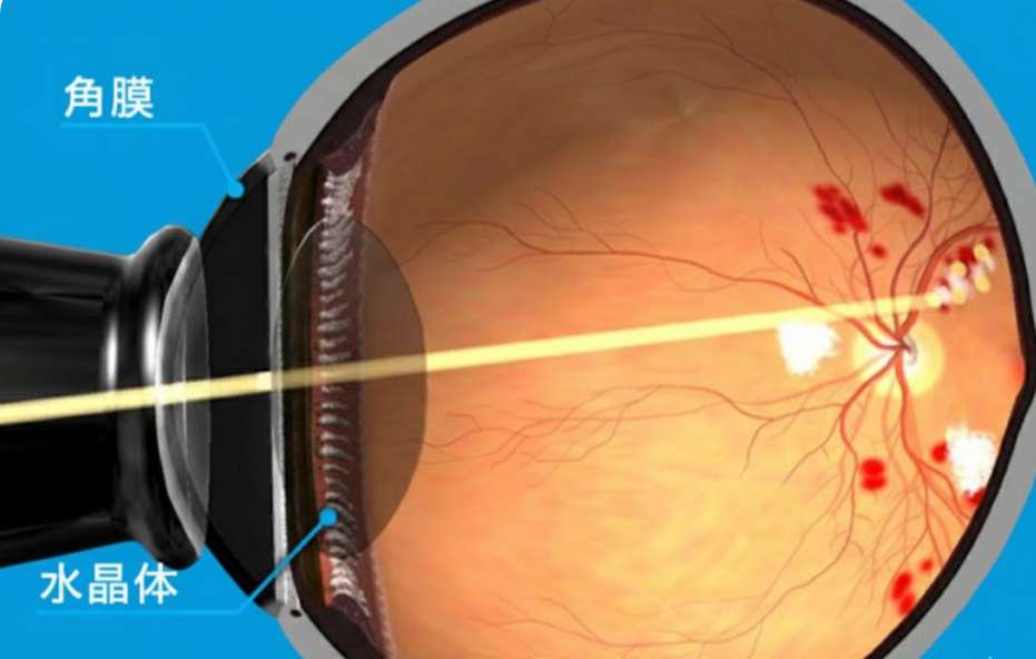 網膜光凝固術のイラスト