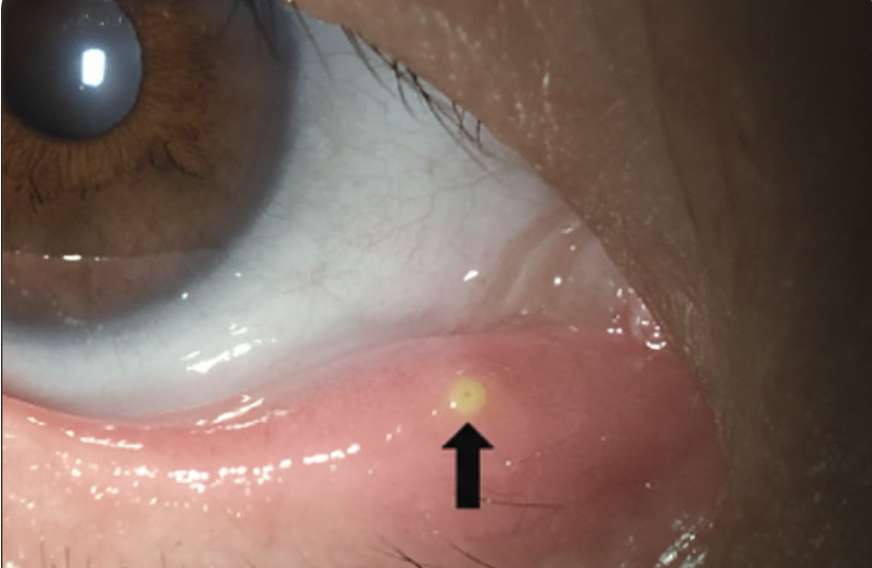 涙点プラグ挿入手順の図解