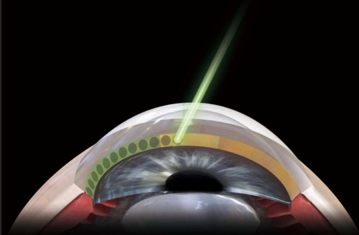 緑内障の視神経ダメージ