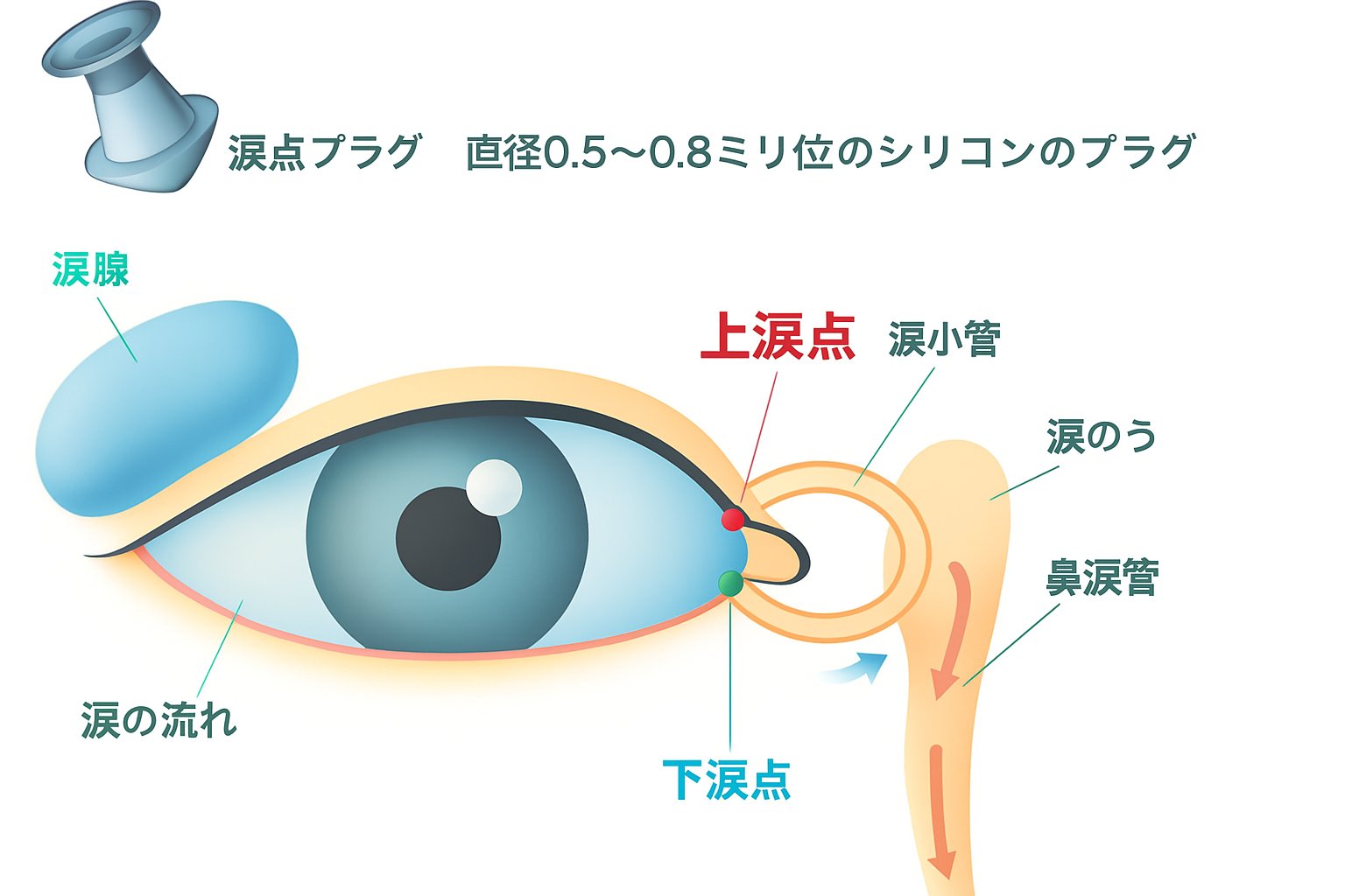 涙点プラグの仕組み - 涙の流れと涙点の位置を示す医療図